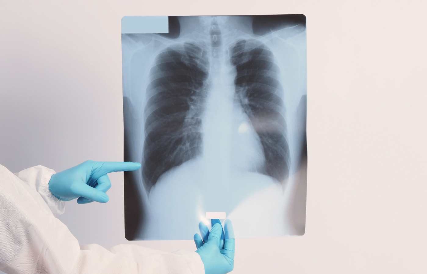 How early can you detect mesothelioma? : Early Diagnosis Guide