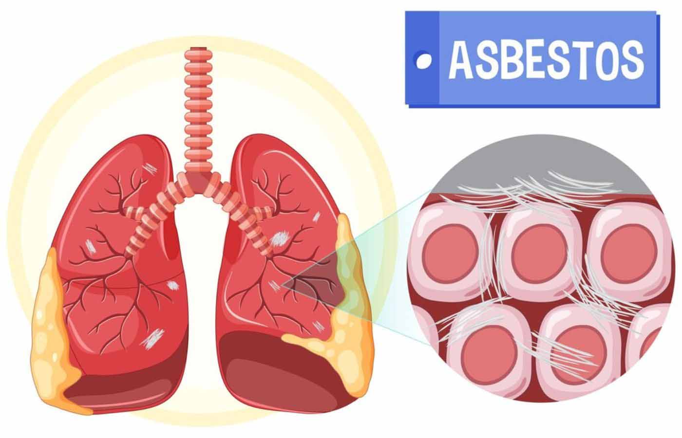 Recognizing and Understanding Asbestos Symptoms of Asbestos Mesothelioma: An Overview